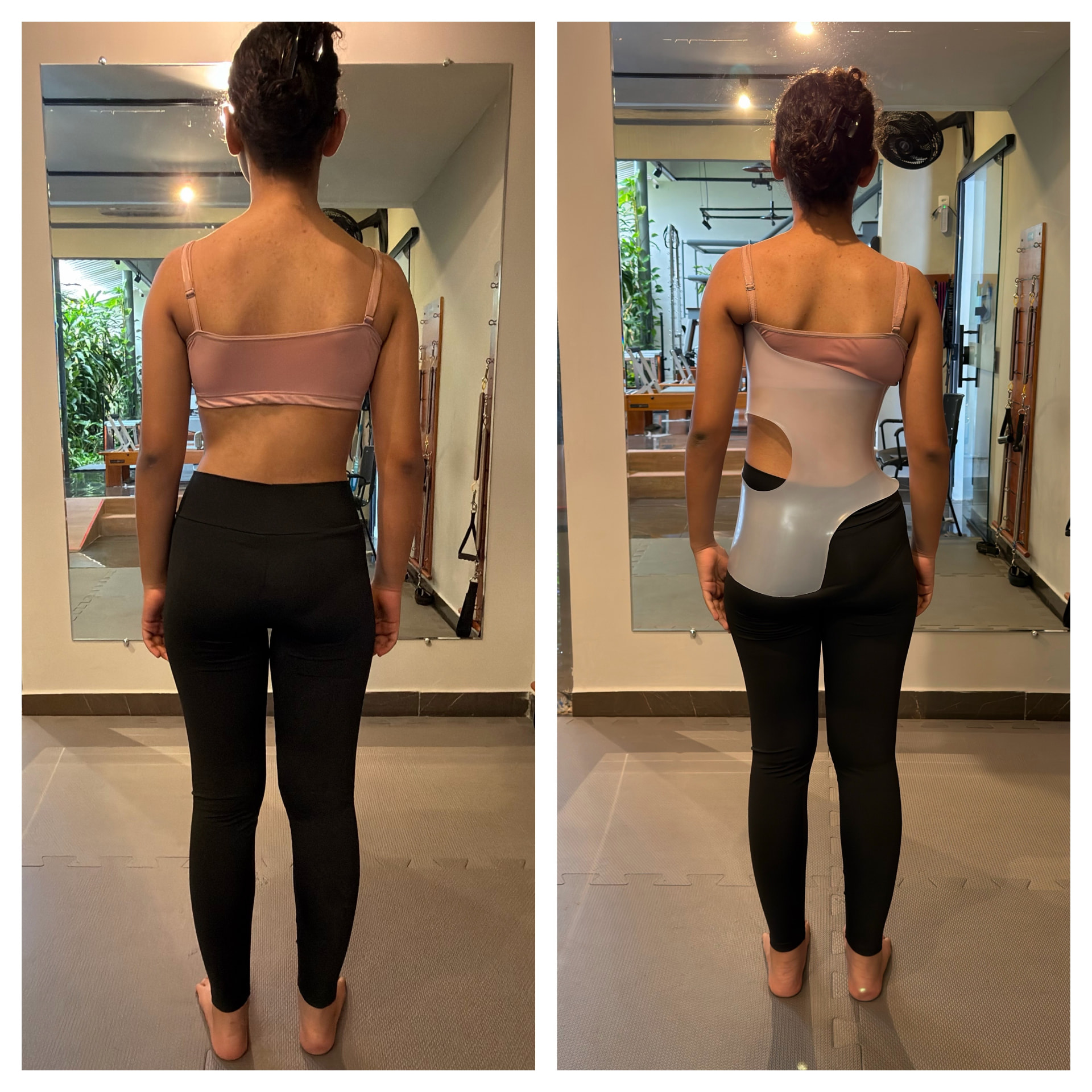 Paciente de costas, antes e depois de vestir o colete tridimensional
