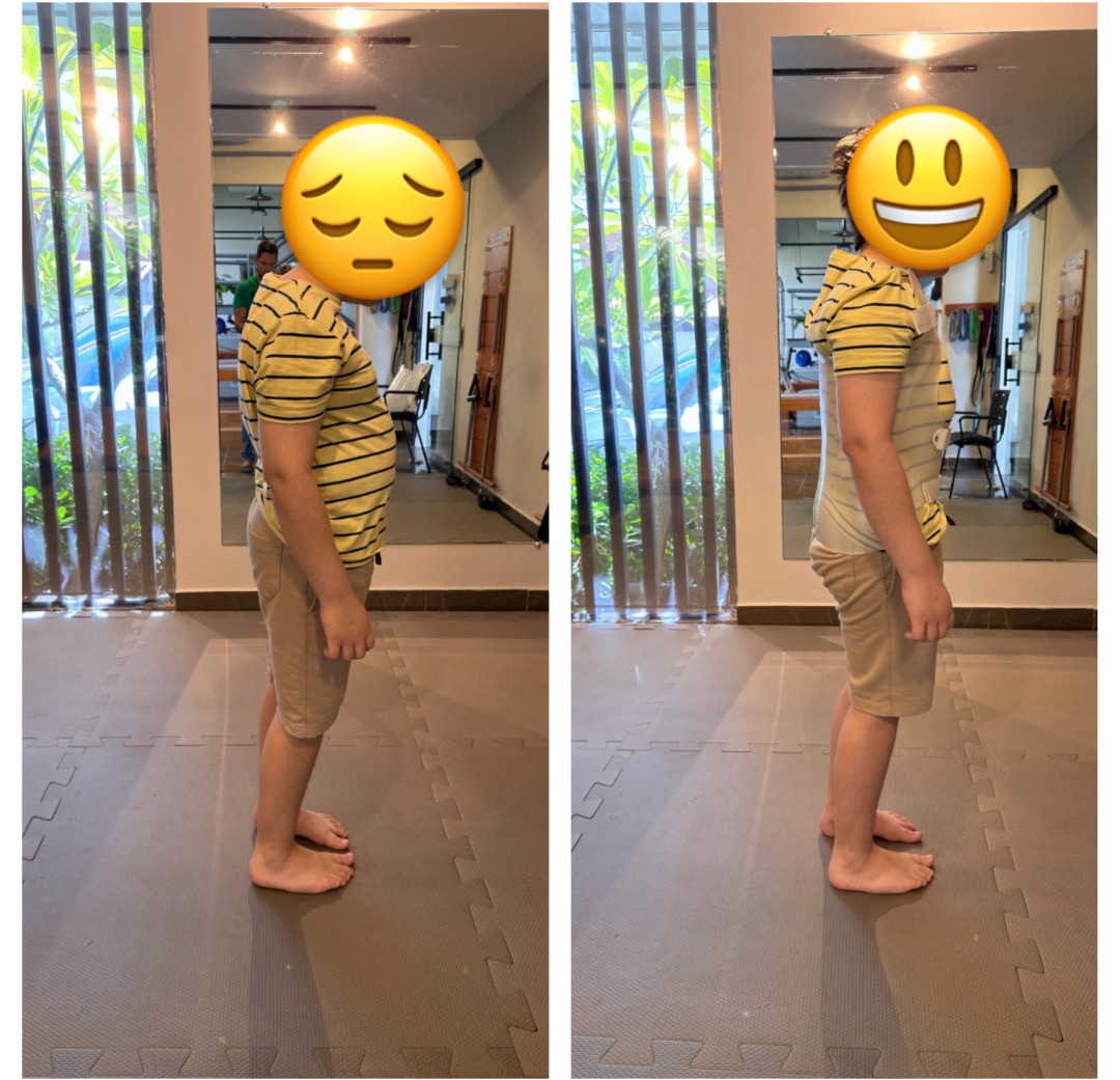 Paciente de perfil, antes e depois de vestir o colete tridimensional