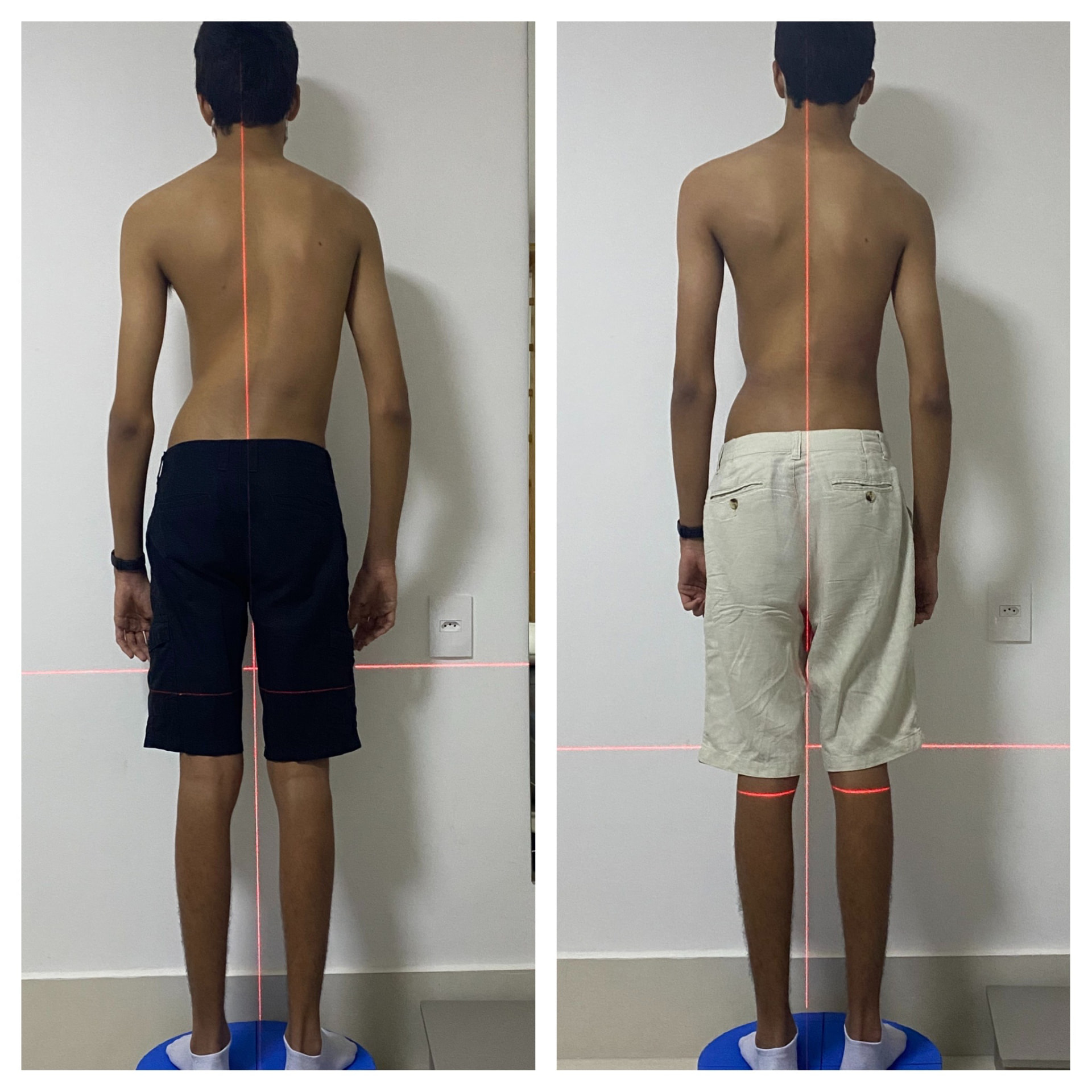 Antes e depois da avaliação postural de um paciente adolescente