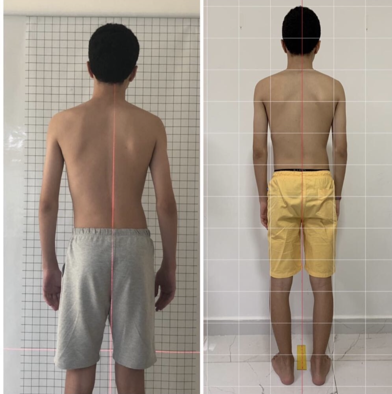 Antes e depois do alinhamento da coluna de um paciente adolescente